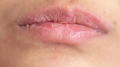 مفاجأة غير سارة عن أوميكرون.. أعراض جلدية