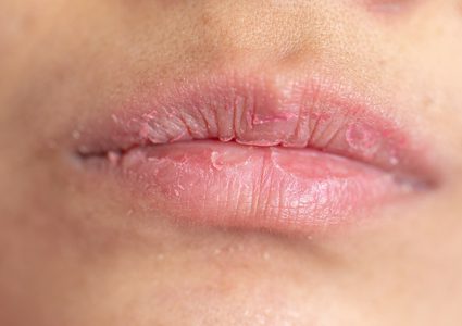 مفاجأة غير سارة عن أوميكرون.. أعراض جلدية