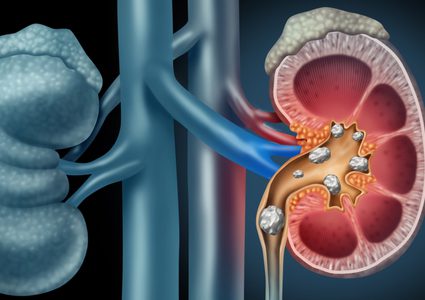 أعراض حصوات الكلى وطرق الوقاية والعلاج منها