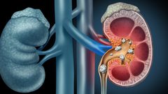 أعراض حصوات الكلى وطرق الوقاية والعلاج منها