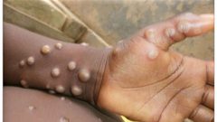 بريطانيا تعلن تسجيل إصابة بشرية بمرض معدٍ ونادر وهو "جدري القرود"