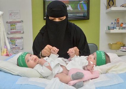 إنجاز طبي سعودي بفصل توأمين سياميين