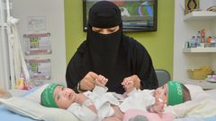 إنجاز طبي سعودي بفصل توأمين سياميين