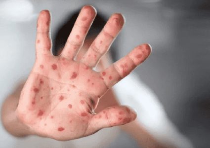 جدري القردة.. المرض الذي يخشى العالم من تفشيه بعد كورونا