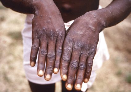 جدري القرود: إصابة في إسرائيل وعدة إصابات حول العالم