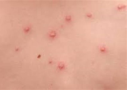 الصحة العالمية تكشف أهم أسباب تفشي جدري القرود