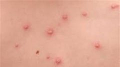 الصحة العالمية تكشف أهم أسباب تفشي جدري القرود