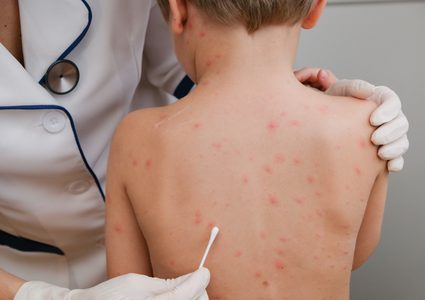 الأرجنتين ترصد أول حالة يشتبه بإصابتها بجدري القرود