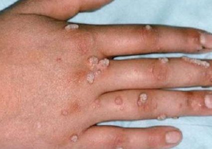 ارتفاع عدد الإصابات بـ"جدري القرود" في كندا إلى 15 حالة