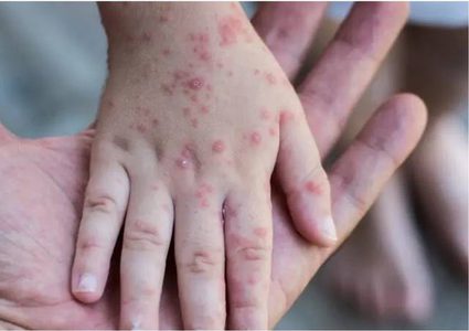 طلب عاجل من منظمة الصحة العالمية لاحتواء جدري القرود