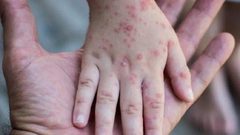 700 إصابة بجدري القرود حول العالم