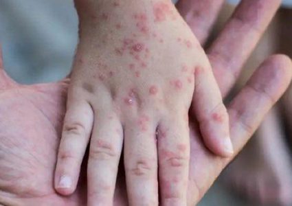 700 إصابة بجدري القرود حول العالم