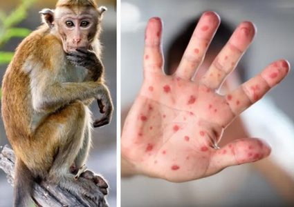 الإمارات تسجل 5 حالات جديدة بفيروس جدري القرود