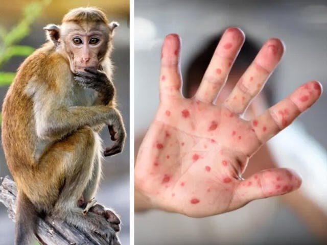 الإمارات تسجل 5 حالات جديدة بفيروس جدري القرود