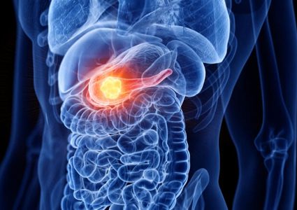 علاج مفاجئ لمرضى سرطان البنكرياس