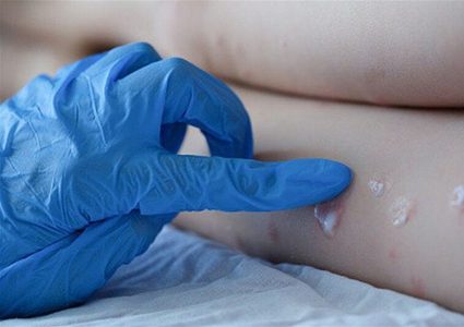 تحذير من خطورة جدري القرود بعدة دول