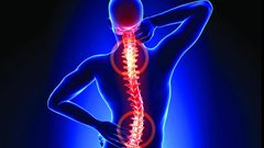 دواء واعد يعالج حالات "الديسك" الصعبة في العمود الفقري