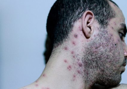 الصحة العالمية تدرس تصنيف جدري القردة "حالة طوارئ"