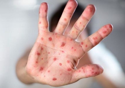 "الصحة العالمية": 2103 حالات إصابة مؤكدة بجدري القردة في 42 دولة