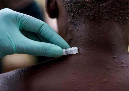 الصحة العالمية: 2103 حالات إصابة مؤكدة بجدري القردة بـ42 دولة