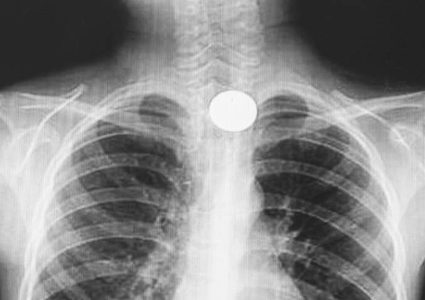 تحذير عاجل من خطر "البطاريات" على الأطفال