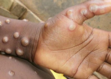 إصابة عدد من جنود جيش الاحتلال بـ (جدري القرود)