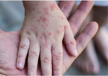 الصحة العالمية تعلن حالة الطوارئ بعد تفشي مرض (جدري القردة) في 70 دولة