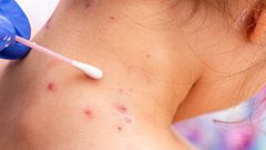 الصحة الإماراتية: رصد 3 حالات جديدة لجدري القردة