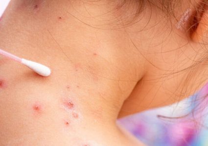 الصحة الإماراتية: رصد 3 حالات جديدة لجدري القردة