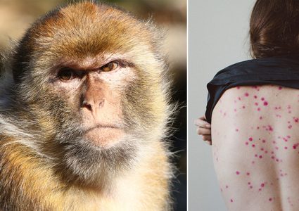 جدري القردة.. مصر ضمن المجموعة الأولى عالميا