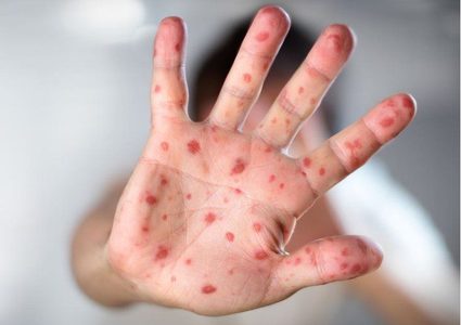 منظمة الصحة: 18 ألف إصابة بجدري القردة في 78 دولة