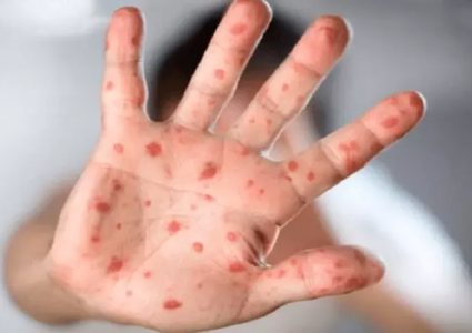 صحيفة: الولايات المتحدة قد تعلن حالة الطوارئ بشأن جدري القردة بحلول نهاية الأسبو