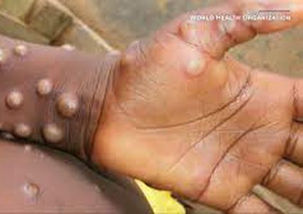 السودان تسجل أول حالة إصابة بجدري القرود