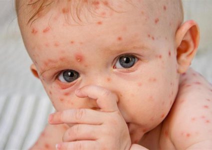 أمريكا تعلن جدري القرود حالة طوارئ صحية