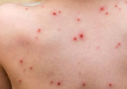 الصحة العالمية تعلنورصد اول حالة جدري القرود انتقلت من البشر للحيوان