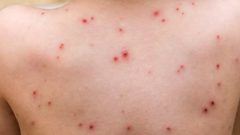 الصحة العالمية تعلنورصد اول حالة جدري القرود انتقلت من البشر للحيوان