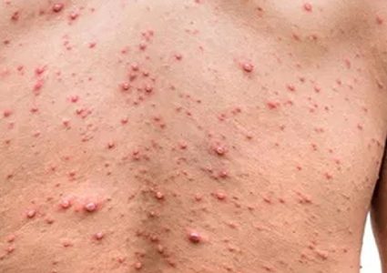 كندا تؤكد تسجيل 1206 حالات إصابة بجدري القرود