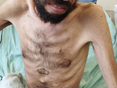 صور مؤلمة  تظهر الوضع الصحي الخطير الذي وصل له الأسير المضرب عن الطعام خليل عواودة