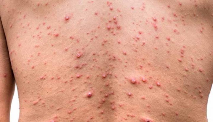 مصر تسجل أول حالة إصابة بجدري القرود