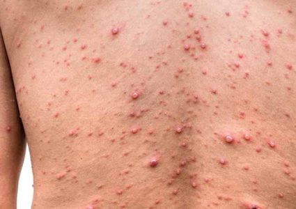 مصر تسجل أول حالة إصابة بجدري القرود