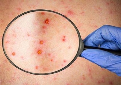 تأكيد أول حالة وفاة بجدري القردة في الولايات المتحدة