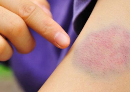 أطعمة قد تمنع حركة الدم بشكل صحيح وتسبب الجلطات