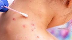 "الصحة العالمية": 26 وفاة وأكثر من 70 ألف إصابة بجدري القردة