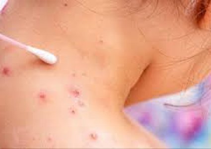 "الصحة العالمية": 26 وفاة وأكثر من 70 ألف إصابة بجدري القردة