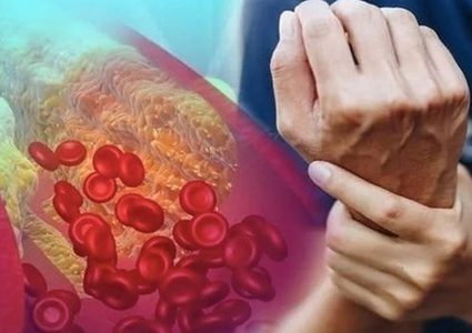 ما هي الأسباب الرئيسية لارتفاع الكوليسترول؟