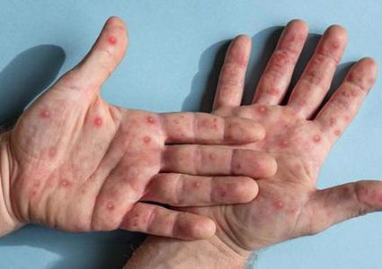 "إم بوكس" الاسم الجديد لجدري القردة