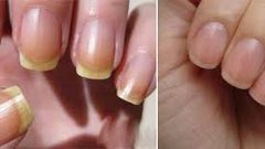 ما هي أسباب اصفرار الأظافر؟