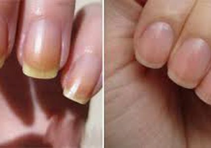 ما هي أسباب اصفرار الأظافر؟