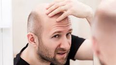 مشروبات شائعة تؤدي إلى الصلع