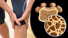 طرق الوقاية من هشاشة العظام